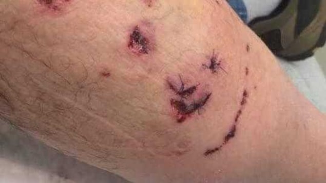 Marty Marin a été mordu par un chien de la police de Regina le 4 juillet. Marty Marin a été mordu par un chien de la police de Regina le 4 juillet.