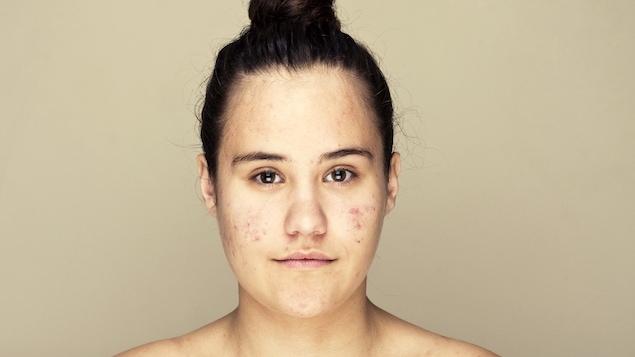 Une adolescente atteinte d'acné regarde la caméra.