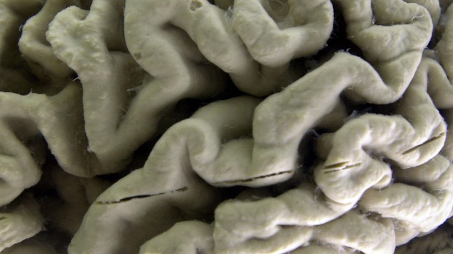 Portion du cerveau d'une personne ayant souffert de la maladie d'Alzheimer.