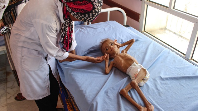 Une infirmière se penche sur un enfant souffrant de famine étendu sur un lit.