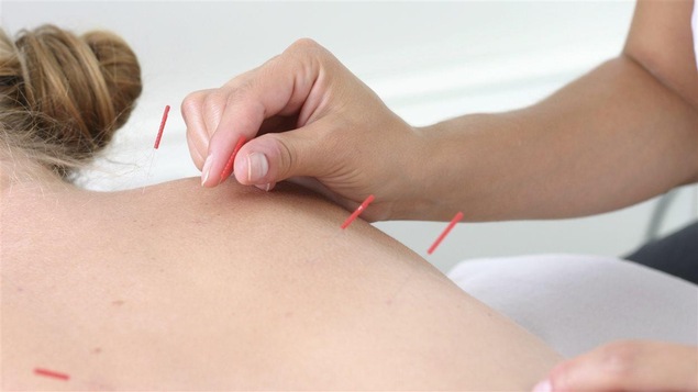 Une séance d'acupunture