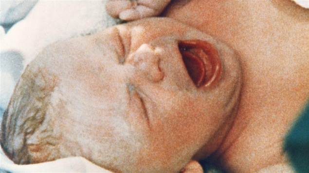 Louise Brown, premier bébé éprouvette, à sa naissance le 25 juillet 1978