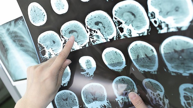 Un expert analyse les images d'un cerveau.