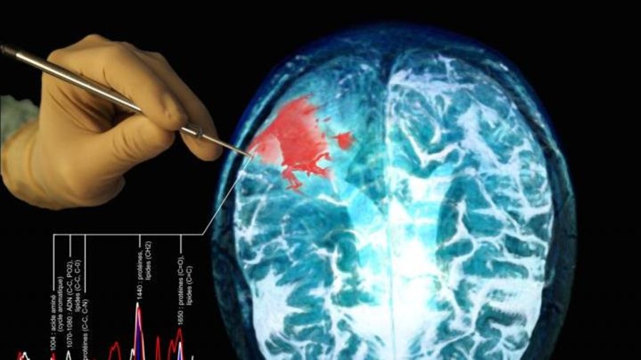 Cellules cancéreuses au cerveau Cellules cancéreuses au cerveau
