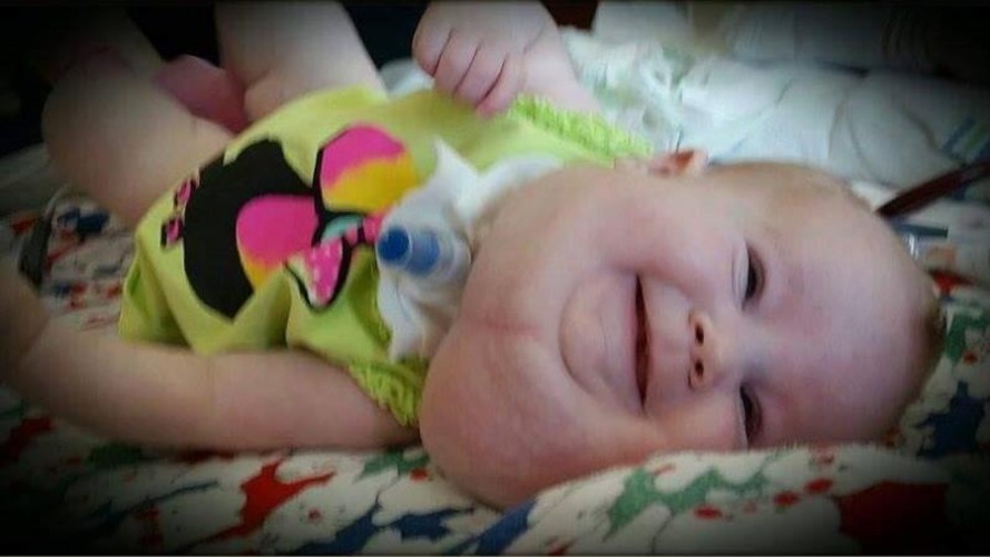 Une petite fille couchée atteinte d'une malformation du système lymphatique qui se forme généralement dans le cou Une petite fille couchée atteinte d'une malformation du système lymphatique qui se forme généralement dans le cou